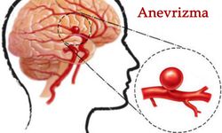 Beyin anevrizması nedir? Beyin anevrizması belirtileri neler? Beyin anevrizması  ölümcül mü?