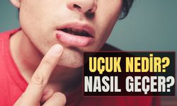 Uçuk nedir? Uçuk neden çıkar? Uçuk nasıl geçer? Uçuk ilacı var mı?