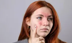 Kelebek Hastalığı (Lupus) nedir? Sakarya'da Kelebek Hastalığımı var?