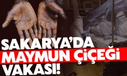 Sakarya'da Maymun Çiçeği hastalığı!