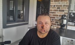 Pitbull Saldırısına Uğrayan Onur Akay Ameliyata Alınıyor