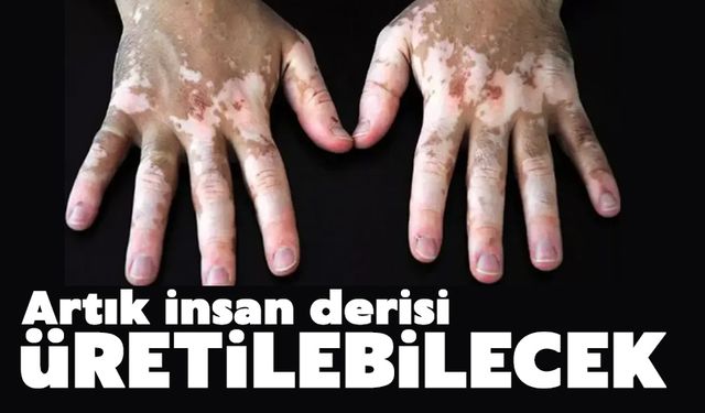 Artık insan derisi üretilebilecek