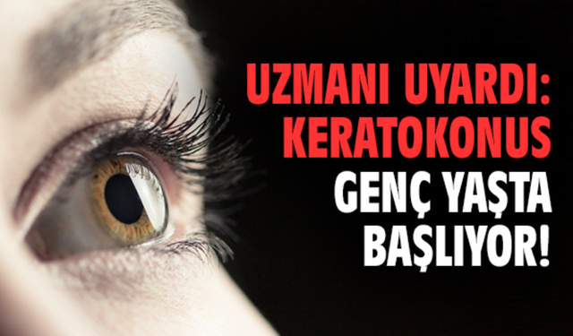 Gençlik Hastalığı Keratokonusta Çapraz Bağlama Tedavisiyle Yüzde 90 Başarı